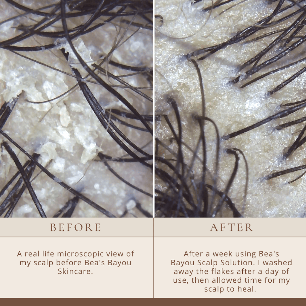 YeastDefense™️ Seborrheic Scalp Solution | Herbal Leave-in